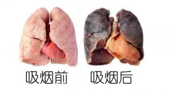 这是抽烟时伤害的肺
